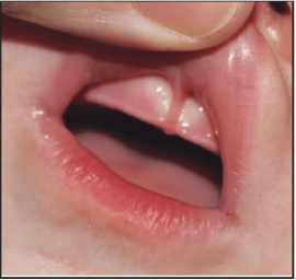 Lip Ties often go hand in hand with tongue ties - here's what to look for