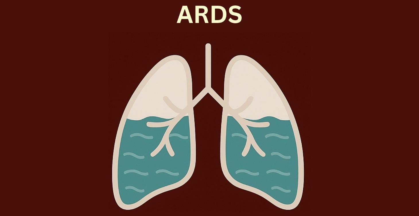 ARDS