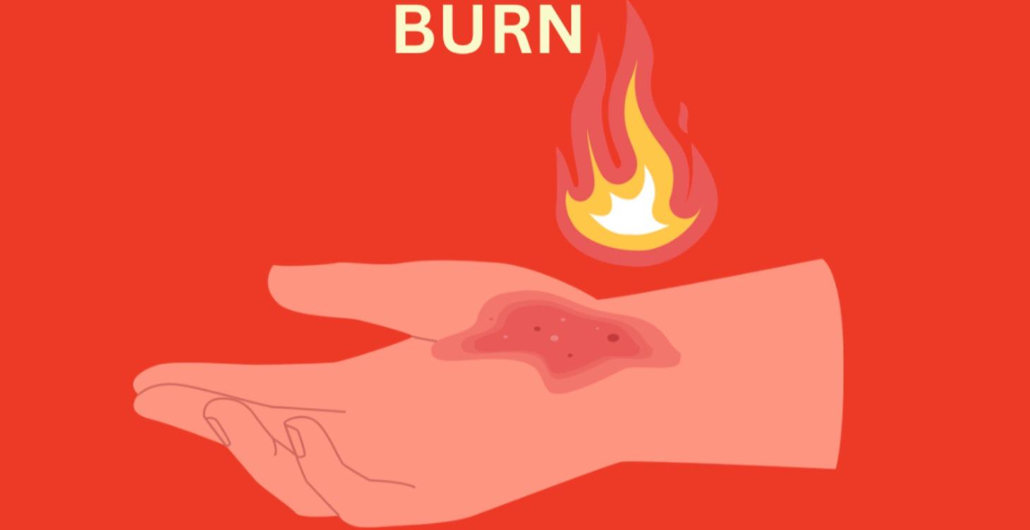 BURN