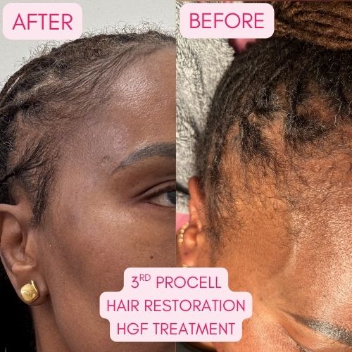 ProCell Hair Growth Resssssuuuults Ya'll 🔥