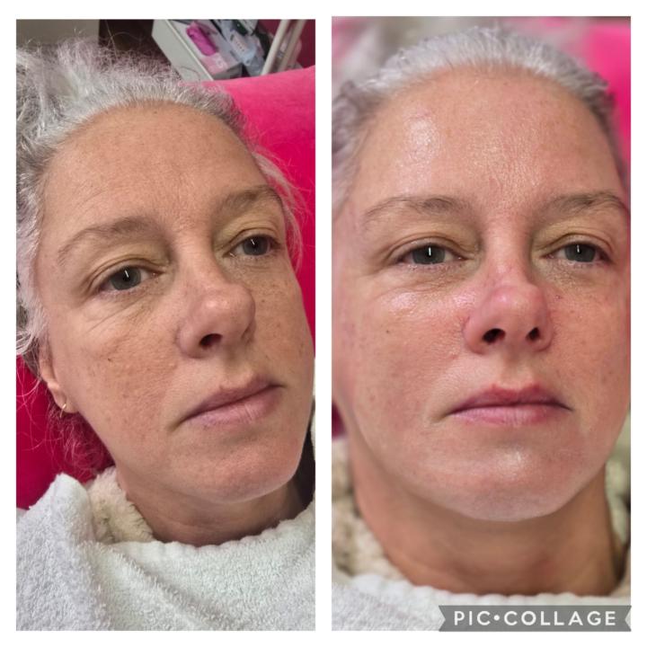 What's a HydroFacial? 💦