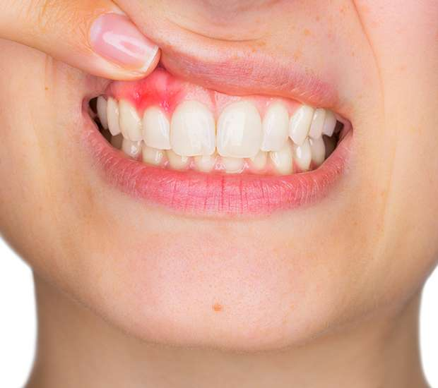 Sonrisa Gingival | Dra. Marta Cuadra — Diagnóstico funcional y estética