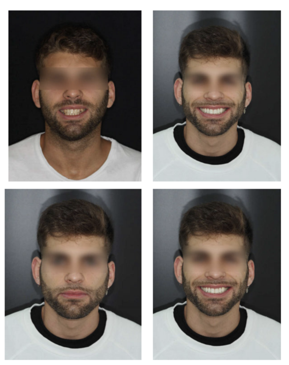  Invisalign Diamond Apex 💎 | Dra. Marta Cuadra — Muro de Victorias