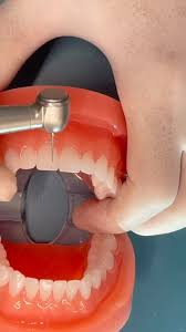 IPR Ortodoncia | Dra. Marta Cuadra — ¿Cuándo hacer el pulido interproximal?