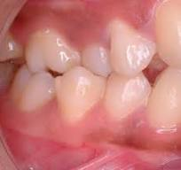 Mordida Cruzada Posterior | Dra. Marta Cuadra — Expansión asimétrica