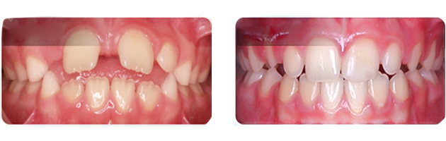 Invisalign First avanzado | Dra. Marta Cuadra — Manejo del espacio