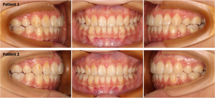 Extracciones en Invisalign | Dra. Marta Cuadra — Gestión del anclaje G6