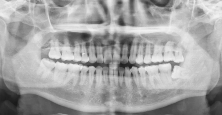 Protocolo PIR y TIR | Dra. Marta Cuadra — Control de incisivos