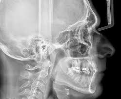 Plano Oclusal | Dra. Marta Cuadra — El error que arruina tu torque 😌