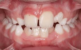 Mordida Cruzada Posterior | Dra. Marta Cuadra — Expansión asimétrica