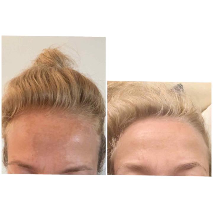 GHK-Cu TREATS MELASMA HYPERPIGMENTATION! 