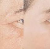 Hyperpigmentation and Melasma