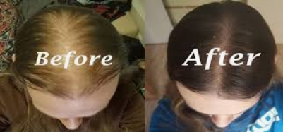 COMING SOON TO MY PJ24 STORE: RU-58841 FOR HAIR LOSS