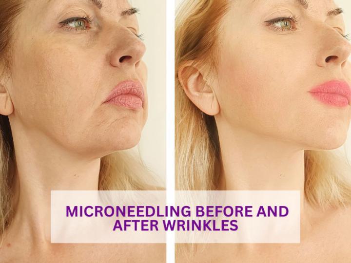 MICRONEEDLING