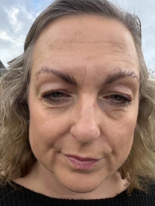 Another allergic reaction