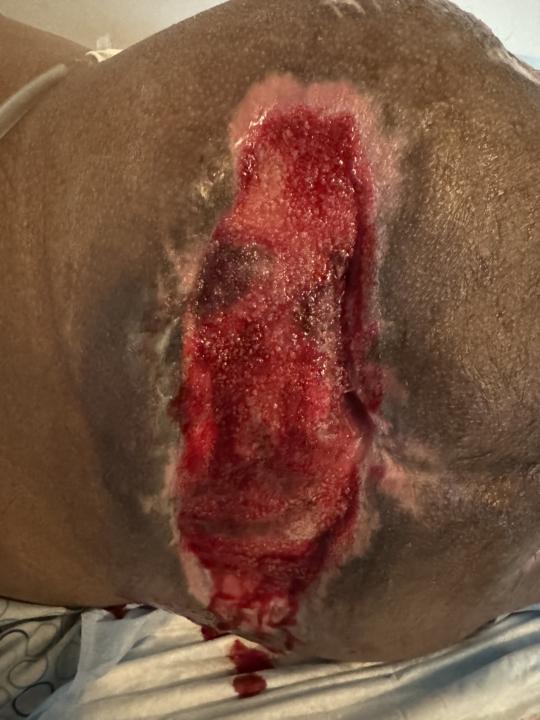 Stage 4 Pressure Ulcer 
