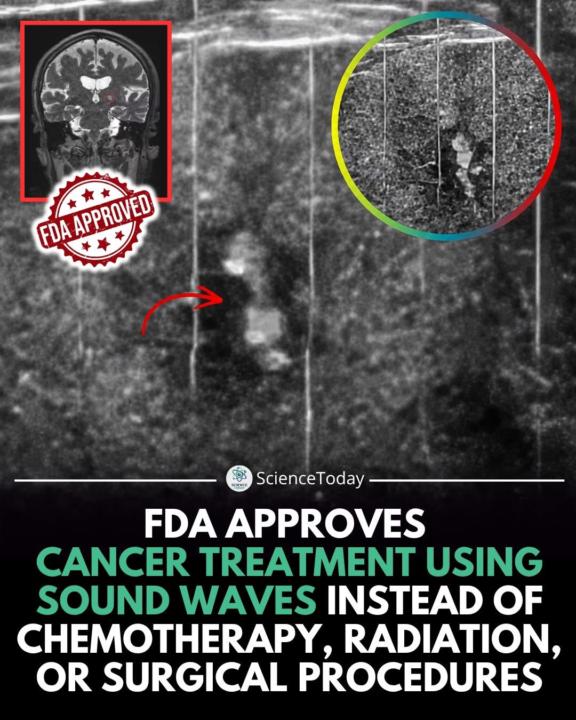 Sound Wave Cancer Treatment Approved!