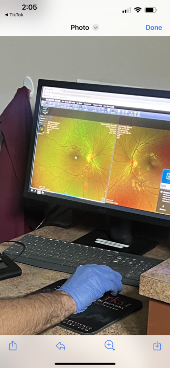 Briana’s Vision Journey: Commotion Retinae with SS-31 and Mots-C  