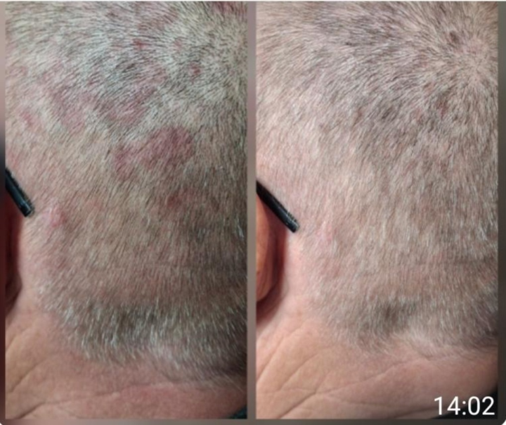Eczema cuir chevelu 