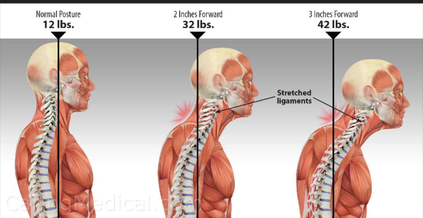 Back/Neck Pain Transformation