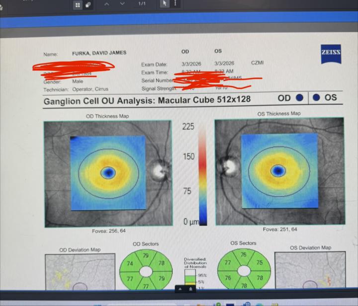 SS-31 heals Macular degeneration! I’m the proof!!