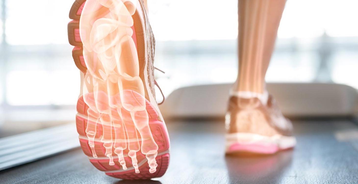 Plantar Fasciitis