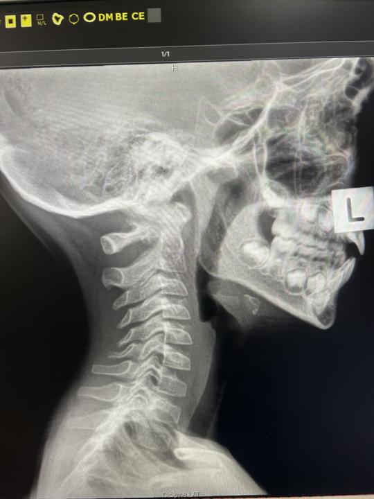 6yo with headaches and neck pain 