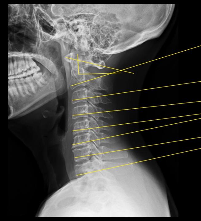 Ehlers Danlos patient 