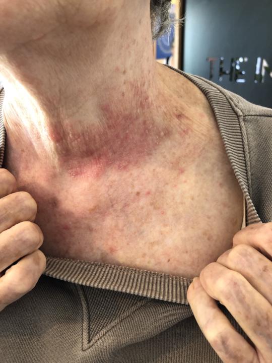 Rash/skin condition 