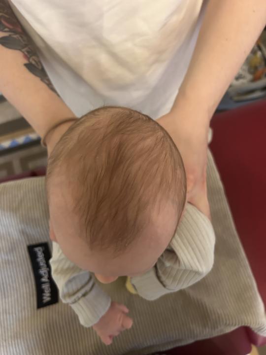Plagiocephaly baby