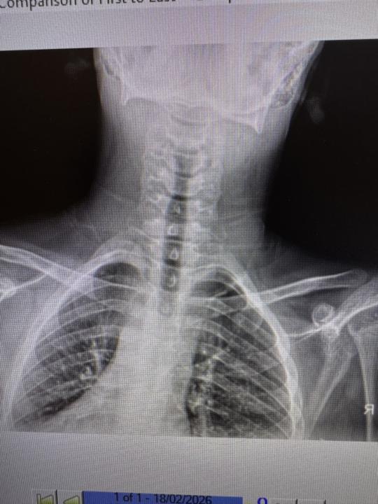 Moebius syndrome kid