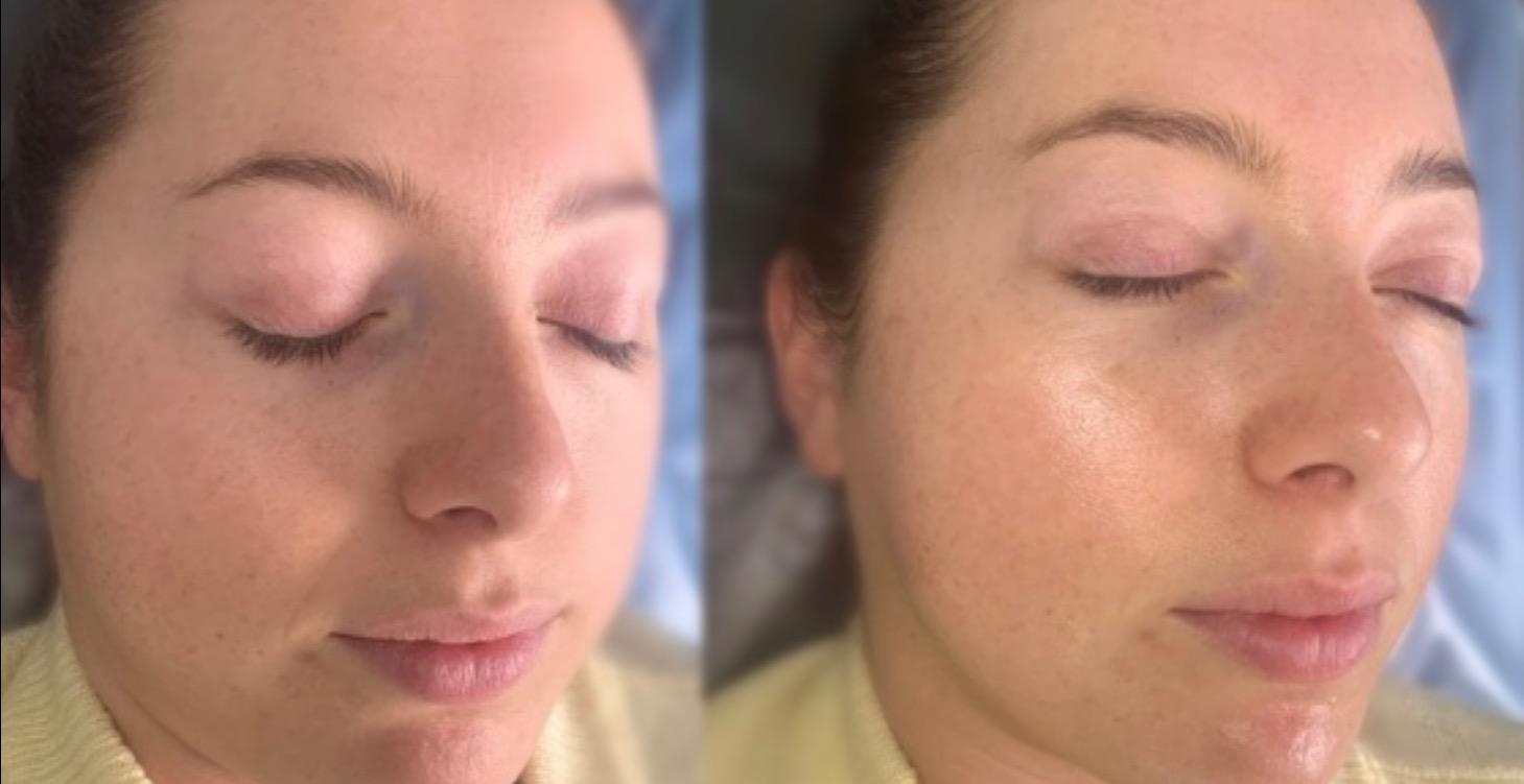 At-home dermaplaning