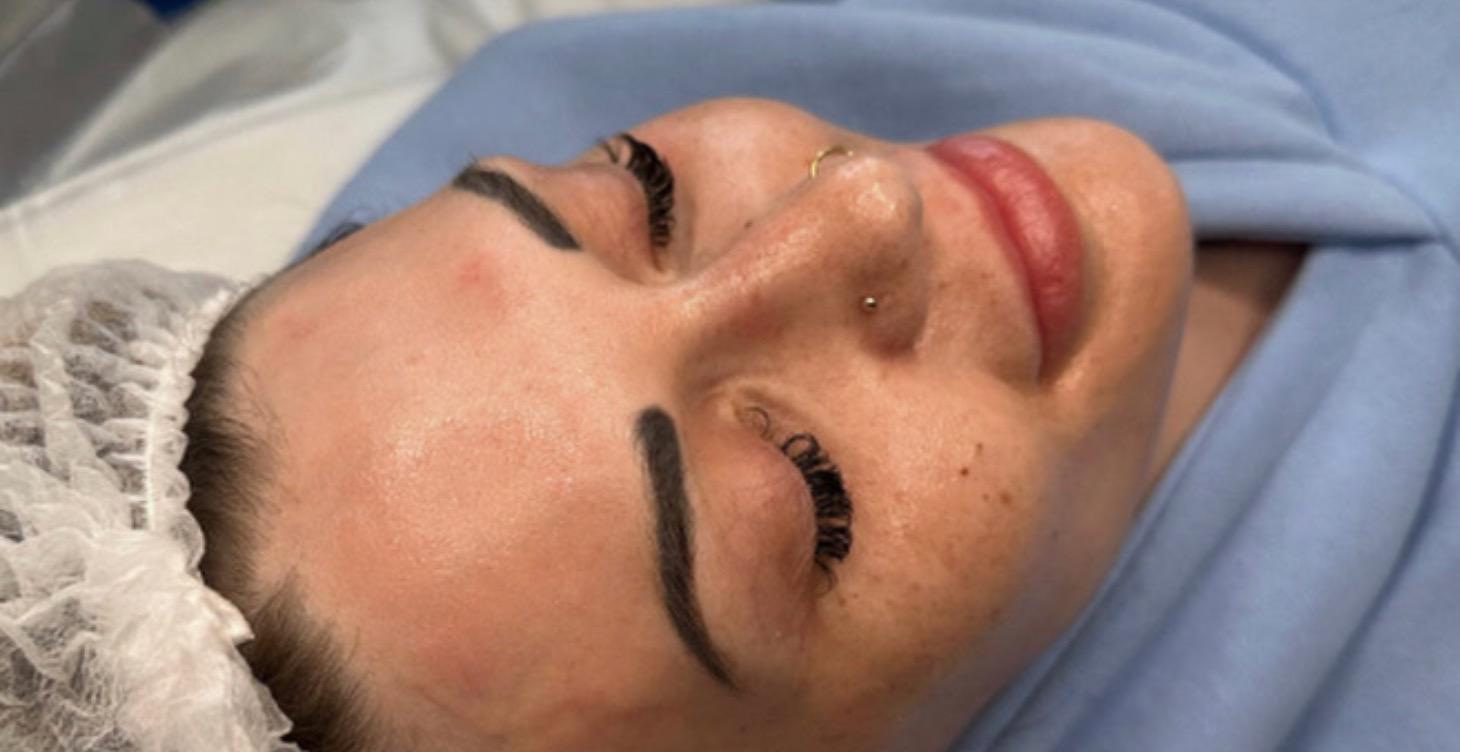 At-home microneedling