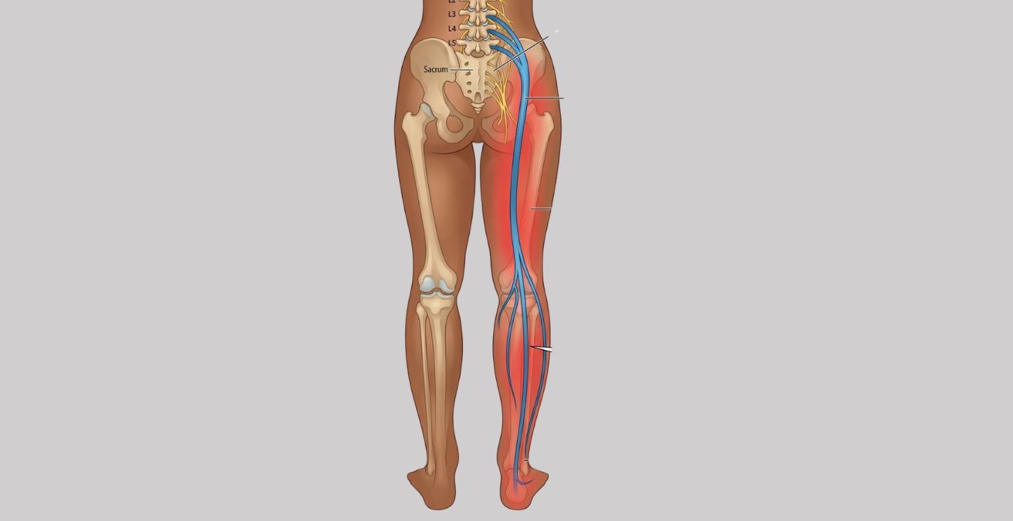 Sciatica