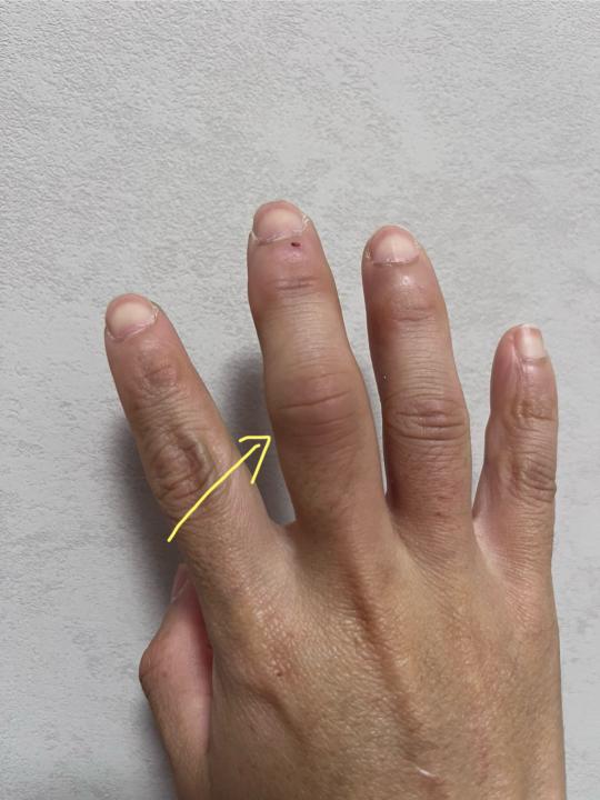 Finger injury