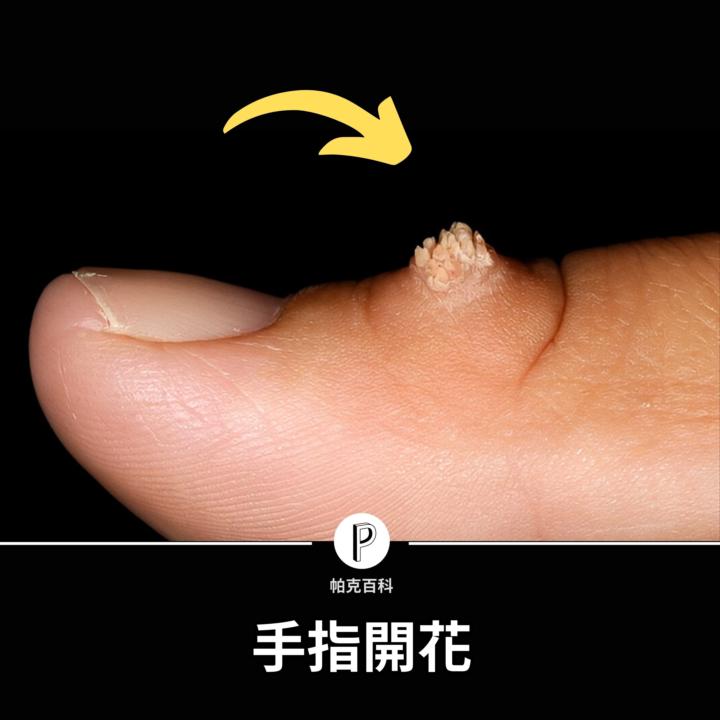 病毒疣影片的資料補充