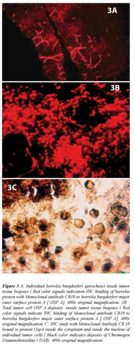 🦠 Could a hidden infection be fueling certain brain tumors?