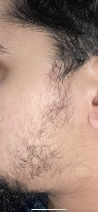 Need help with growing beard on the sides