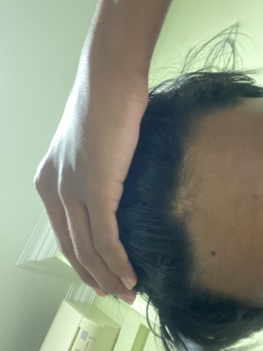 Hair recession 