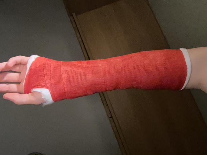 Broken bone