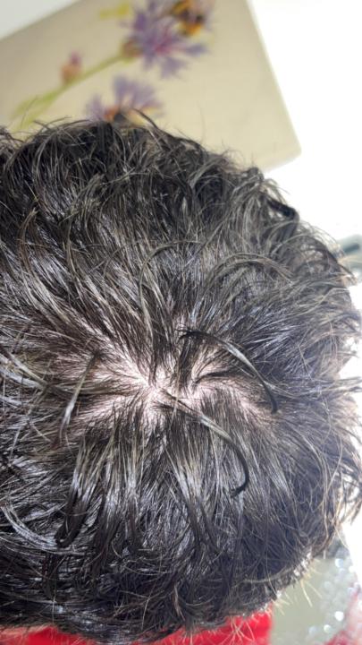Hair loss or normal crown? 
