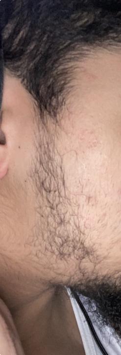 Beard minoxidil progress