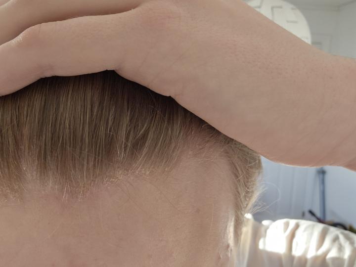 Dry scalp?