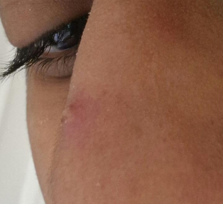 Ive got a big spot on my nose