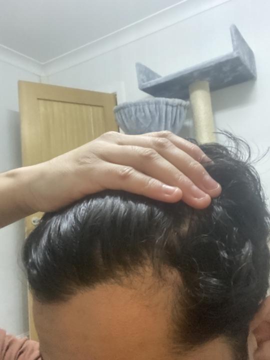Am I balding at 19 and do I need minoxidil?
