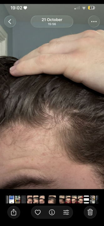 Hair loss/Damage