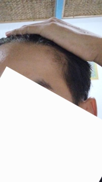 Am I balding?