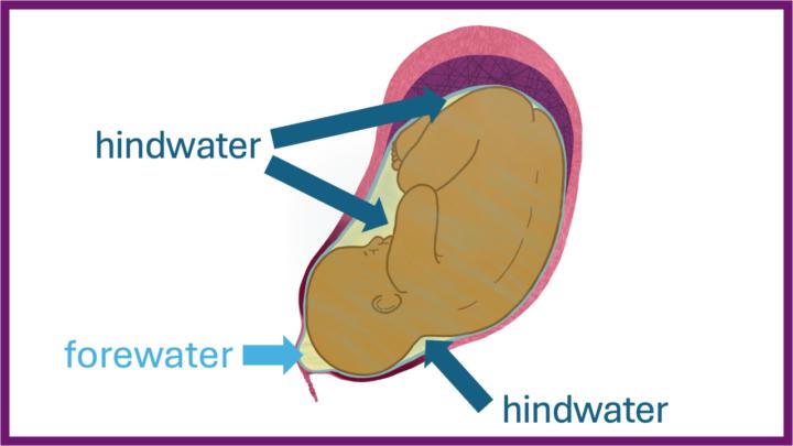 Rupture prématurée des membranes (RPM)
