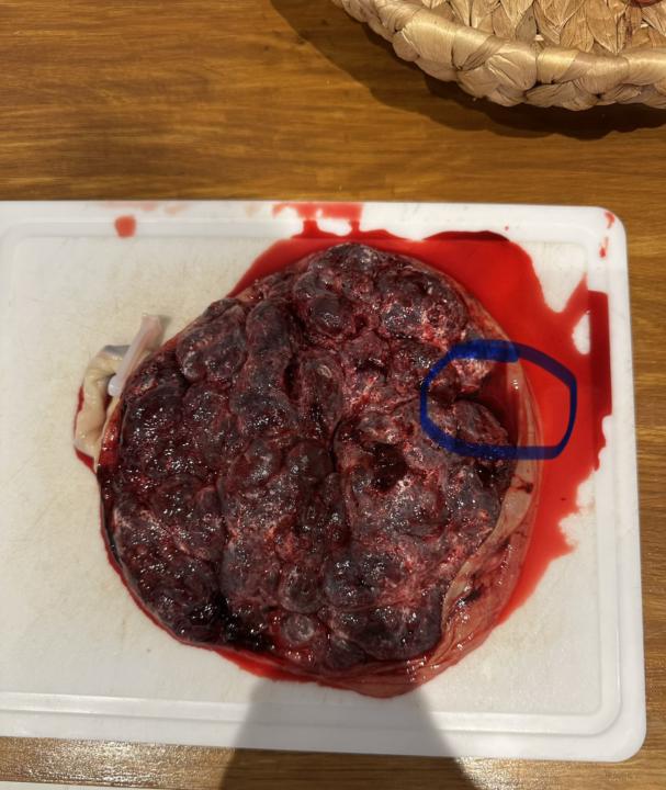 Placenta complet ? 