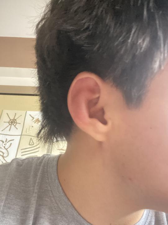 Oreja de coliflor